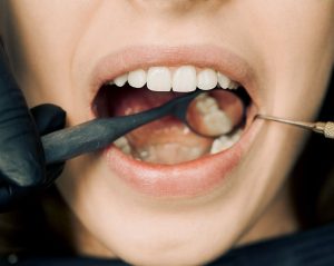Kaip atliekama burnos higiena?